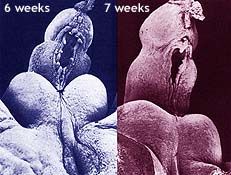 Hypospadias photos: misplaced urinary openings occur in 6-7th week after conception